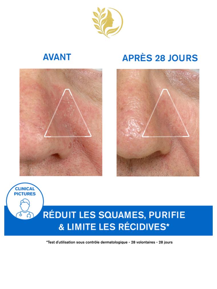 URIAGE DS - ÉMULSION APAISANTE RÉGULATRICE DIMINUTION DES SQUAMES ET ROUGEURS - 40 ML -